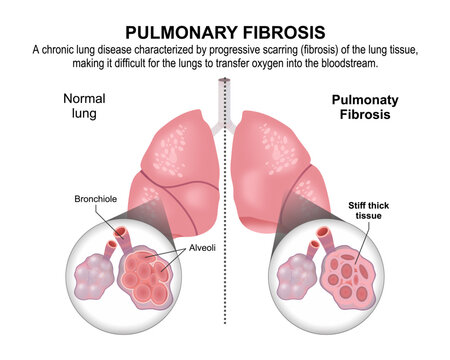 Pulmonary Fibrosis, Lung Flashcard Illustration