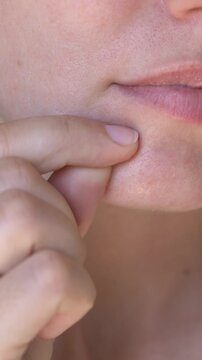 Close-up footage of woman applying hydrocolloid acne patch on chin with visible blemish and redness. Realistic skincare treatment concept for cosmetic brands and dermatology services.