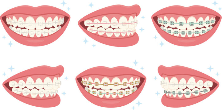 Orthodontic Braces Collection with Metal Ceramic and Clear Aligner Dental Treatment Vector Illustration Set