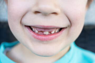 Macro dental health shot of a young child's cheerful smile showing the early stages of permanent tooth eruption in the upper jaw. © Phoscar