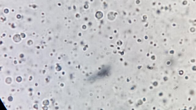 Oligozoospermia and asthenozoospermia with evidance of infection. Plenty of pus cells are seen. Microscopic footage of abnormal sparm count.
