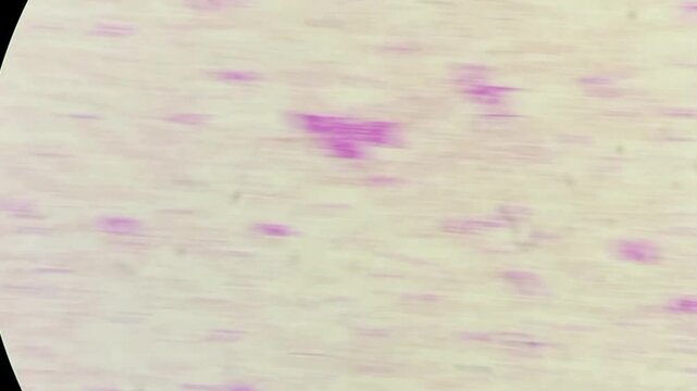 Normocytic normochromic anaemia with leucocytosis and thrombocytosis. Microscopic footage of blood cells. 