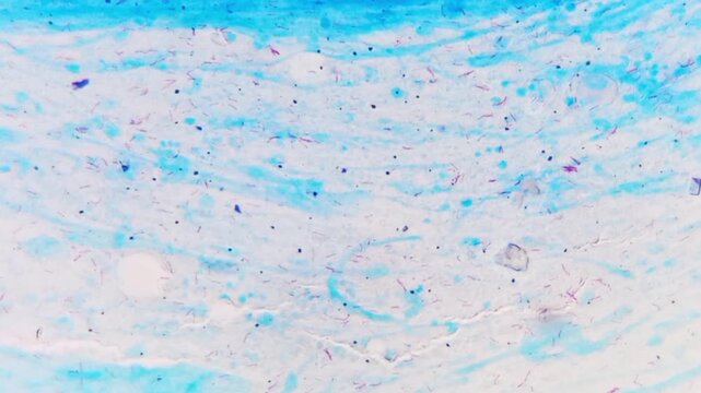 Sputum smear AFB stain microscopic footage plenty of mycobacterium tuberculosis bacteria. Acid Fast Bacilli (AFB) positive (4+).