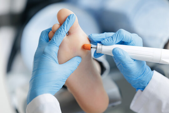 Podiatrist treating foot with tool in medical setting, removal of calluses and corns