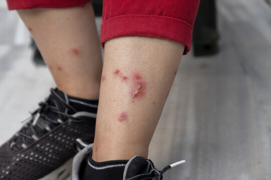 Allergic skin reaction with red bite marks on woman's leg. Healthcare concept.