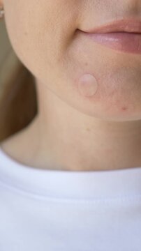 Transparent hydrocolloid patch on female chin during daily skincare routine. Modern invisible acne treatment concept for beauty brands, dermatology clinics and cosmetic advertising.