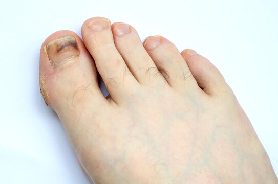 Close-Up Of Foot With Blackened Toenail Injury Showing Damaged Big Toe And Discolored Nail