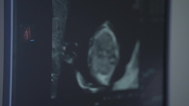 Ultrasound Monitor Displaying Fetal Image During Prenatal Examination