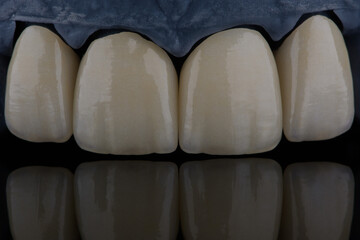 High-quality four dental crowns made of zirconium for fixation to the frontal teeth of upper jaw. © gorynvd