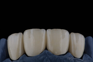 High-quality four dental crowns made of zirconium for fixation to the frontal teeth of upper jaw. © gorynvd
