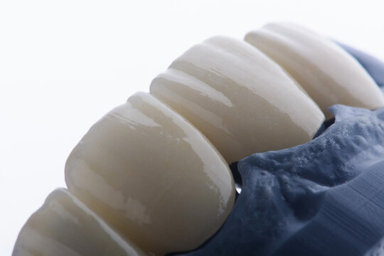 High-quality four dental crowns made of zirconium for fixation to the frontal teeth of upper jaw.