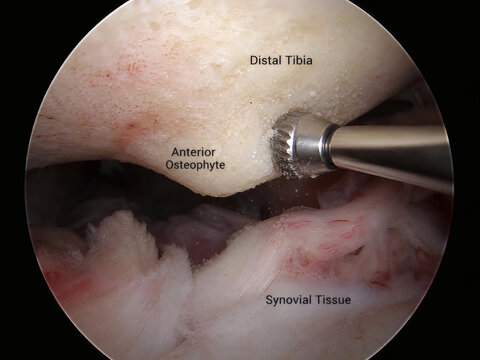 3D medical illustration of ankle arthroscopy view, close-up of surgical burr shaving anterior osteophyte bone spur on distal tibia with text labels.