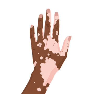 Flat vector illustration of a human hand with vitiligo skin condition, showing depigmented white patches on dark brown skin, isolated on a white background for medical use.
