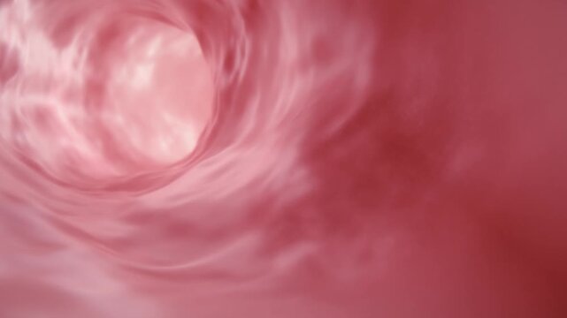 3D Medical Animation: Intestinal Tumor and Colorectal Cancer Treatment, Malignant Intestinal Lesion and Colonoscopy Endoscope Examination