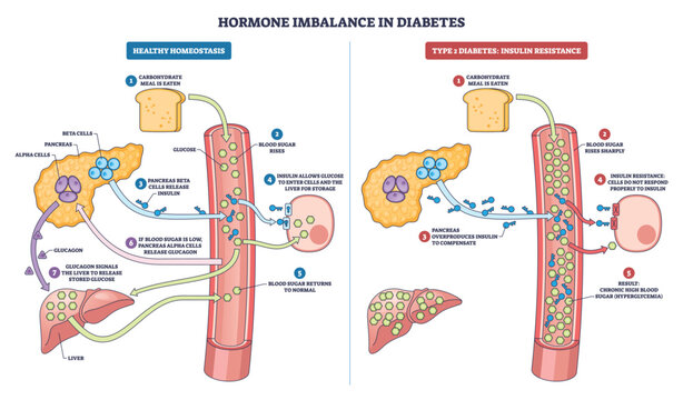 Hormone imbalance in diabetes shown as side-by-side schema of normal vs insulin resistance, highlighting pancreas, blood vessel, and liver regulating glucose and insulin. Outline diagram