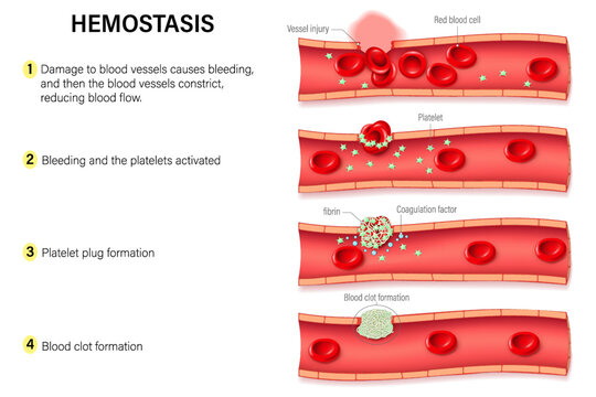 Hemostasis. The hemostatic process. Process to prevent and stop bleeding. Vasoconstriction, platelet plug and blood coagulation.