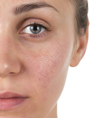 Fototapeta premium Close Up Dry Flaky Skin and Red Irritation on Woman Cheek