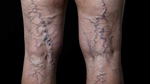 Close-up of Severe Varicose Veins on Back of Human Legs
