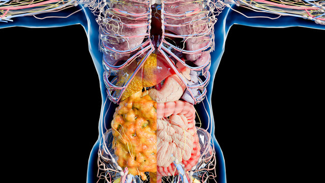 Progressive Accumulation of Visceral Fat and Fatty Liver Disease, Metabolic Syndrome and Internal Fat Gain, Liver and Abdominal Fat Progression, Advanced Steatosis and Visceral Obesity, 3d render