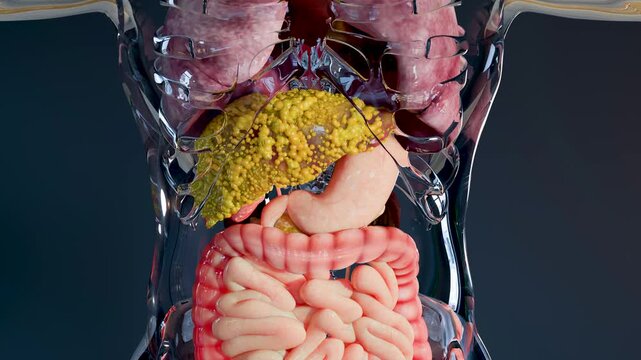 Fatty Liver (Steatosis): Lipid Droplet Accumulation, Hepatic Steatosis: Fatty Liver Disease, Fat Deposits in Liver Cells (Hepatocytes), 3d render