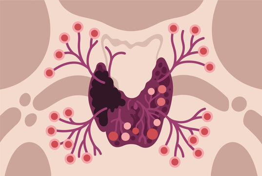 Medical illustration of a human thyroid gland shows various nodules and the surrounding lymphatic system for endocrinology studies.