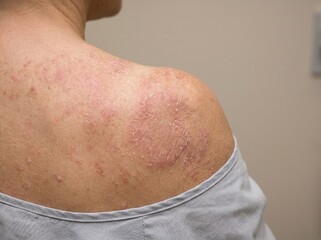 Fototapeta premium Dry Skin Condition on Shoulder Close-Up