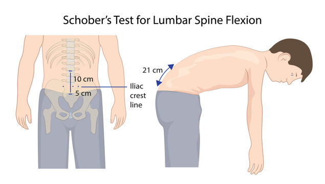 Schober&rsquo;s Test for Lumbar Spine Flexion, demonstrating Schober&rsquo;s test, a clinical method used to assess lumbar spine flexion and mobility.