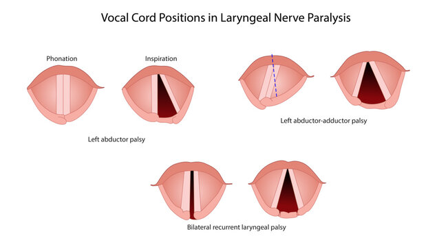 Vocal Cord Positions in Laryngeal Nerve Paralysis depicting vocal cord positions in different types of laryngeal nerve paralysis and their impact on vocal cord movement.