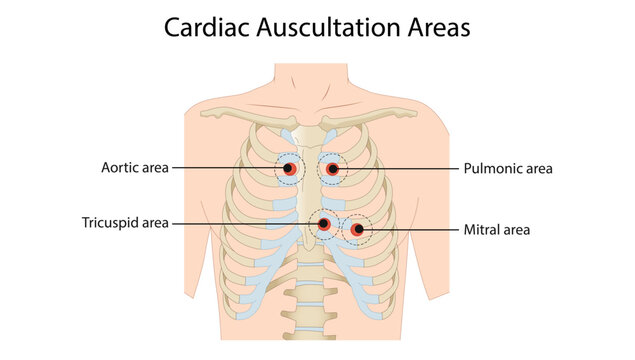Cardiac Auscultation Areas,  cardiac auscultation areas used to assess heart sounds and murmurs associated with the aortic, pulmonic, tricuspid, and mitral valves.