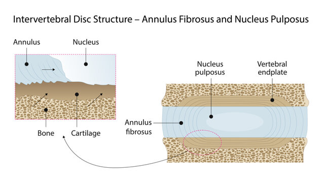 Intervertebral Disc Structure &ndash; Annulus Fibrosus and Nucleus Pulposus, the structure of an intervertebral disc, highlighting the outer annulus fibrosus and central nucleus pulposus responsible.