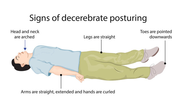 Signs of decerebrate posturing, characterized by extension of the upper and lower limbs, indicating severe brainstem dysfunction or neurological injury.