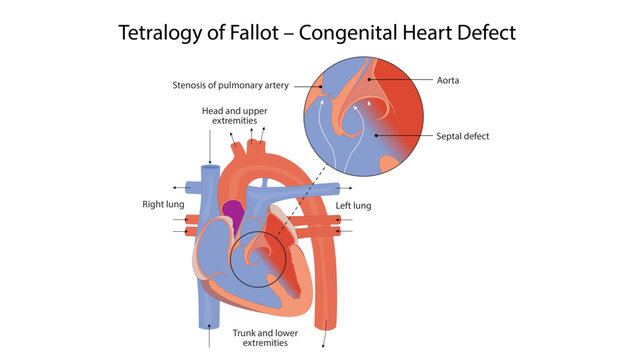 Tetralogy of Fallot &ndash; Congenital Heart Defect, Medical illustration depicting Tetralogy of Fallot, a congenital heart defect characterized by ventricular septal defect, pulmonary stenosis, overriding 