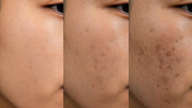 Before and After Acne Treatment Comparison on Young Woman Face, Skin Care Concept