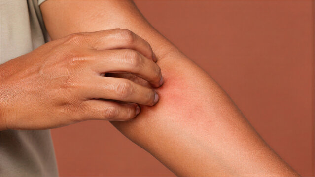 Close-up of a person scratching an itchy red rash on their arm, illustrating skin irritation, dermatitis, or an allergic reaction symptom.