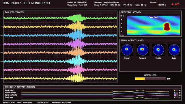 Continuous EEG monitor display showing brain activity and spike waves during a seizure
