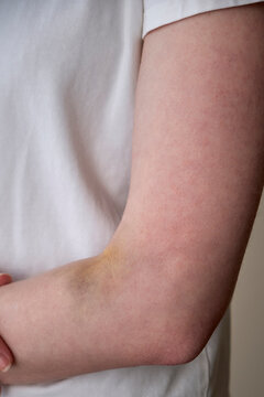 Close-up of a Caucasian female arm featuring a large hematoma (bruise) on the inner elbow area (cubital fossa) caused by an unsuccessful intravenous injection or blood sampling.
