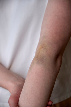Close-up of a Caucasian female arm featuring a large hematoma (bruise) on the inner elbow area (cubital fossa) caused by an unsuccessful intravenous injection or blood sampling.