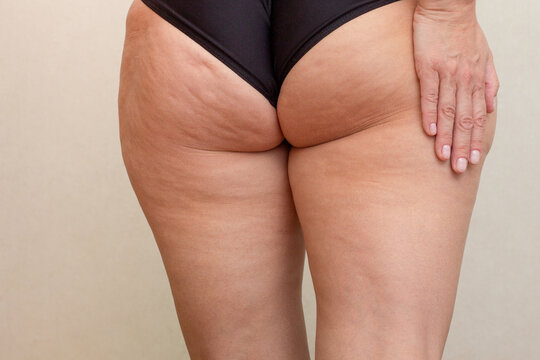 Female hand on thighs and buttocks with cellulite