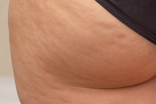 Cropped close up thigh of woman with cellulite dimples