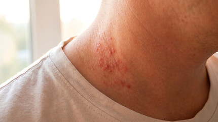 Fototapeta premium Red skin rash bumps on male neck hives allergic reaction insect bite dermatology disease symptom healthcare medical treatment.