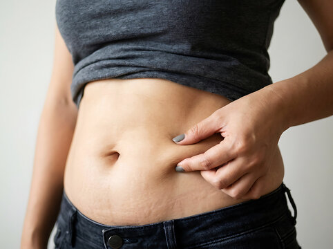 Woman pinching abdomen skin fold showing stretch marks image