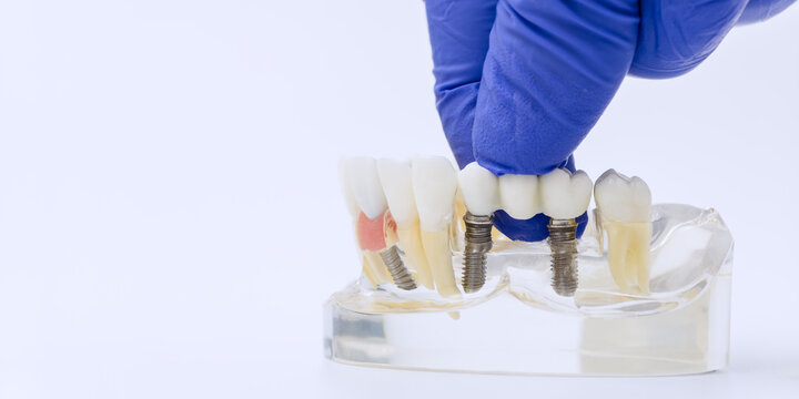Gloved Hand Installing Dental Bridge on Two Implants