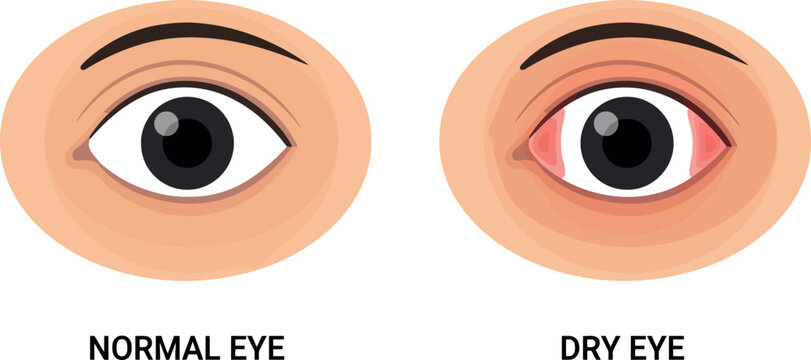 Normal Eye and Red Dry Eye Comparison Vector Illustration Diagram for Ophthalmology Clinic Marketing Optometry Educational Guides and Medical Health Articles