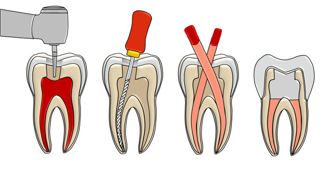 Root Canal Treatment Steps Cross Section Endodontic Therapy Dental Vector - Unlabelled