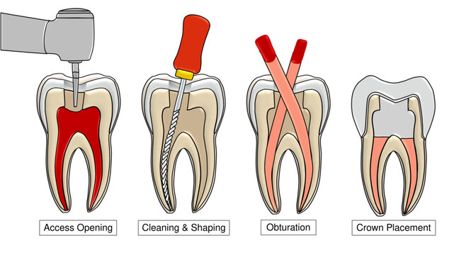 Root Canal Treatment Steps Cross Section Endodontic Therapy Dental Vector - Labelled