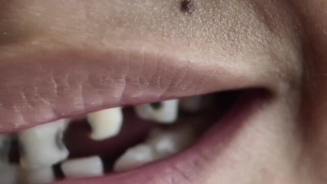 Detailed macro shot of an unhealthy child smile displaying rotten, broken, and extracted primary teeth due to sugar decay. Ideal for dental disease awareness, pediatric healthcare.
