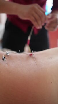 Practitioner Applying Stimulation. Medical Professional Arranging Stimulation Device On Skin. Detailed Image Showing Practitioner Carefully Positioning Red Clip On Needle During Treatment Session