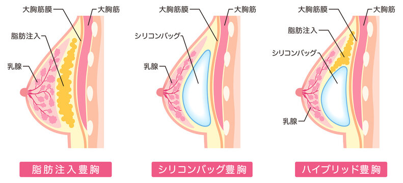 豊胸手術の種類　美容整形　胸