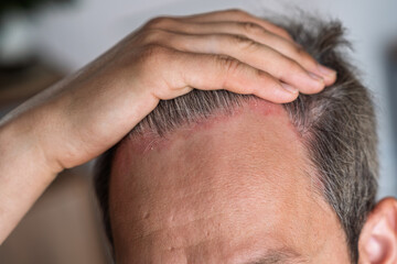 Naklejka premium Man with psoriasis on his scalp gently touches his head, revealing red patches and irritation in a bright indoor environment