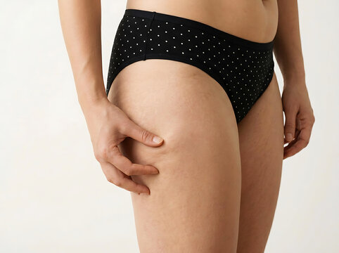 Woman's hand pinching thigh showing cellulite and stretch marks image